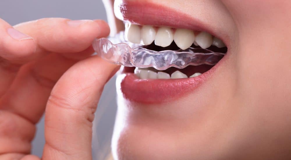Which Factors Determine How Fast Clear Aligners Will Work?